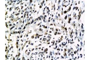 Formalin-fixed and paraffin embedded human cervical carcinoma labeled with Anti-NRAS Polyclonal Antibody, Unconjugated (ABIN738336) at 1:200 followed by conjugation to the secondary antibody and DAB staining.