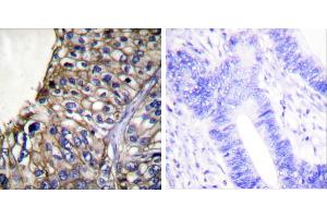 Peptide - +Immunohistochemical analysis of paraffin-embedded human lung carcinoma tissue using Claudin 7 antibody (#C0153). (Claudin 7 antibody)