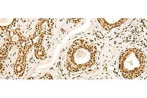 Immunohistochemistry of paraffin-embedded Human breast cancer tissue using ILF3 Polyclonal Antibody at dilution of 1:60(x200)
