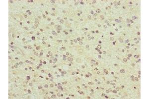 Immunohistochemistry of paraffin-embedded human glioma using ABIN7166519 at dilution of 1:100 (PCDHA12 antibody  (AA 862-941))