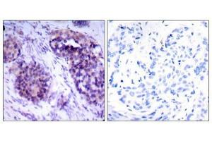 Immunohistochemical analysis of paraffin-embedded human breast carcinoma tissue using BCL-XL (phospho-Ser62) antibody. (BCL2L1 antibody  (pSer62))