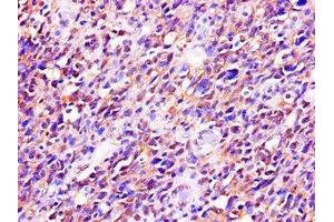 Immunohistochemistry of paraffin-embedded human glioma using ABIN7173542 at dilution of 1:100 (C22orf28 antibody  (AA 52-229))