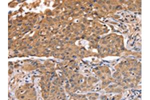 The image on the left is immunohistochemistry of paraffin-embedded Human lung cancer tissue using ABIN7128119(ABCB6 Antibody) at dilution 1/15, on the right is treated with fusion protein.
