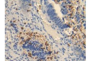 IHC-P analysis of Human Colorectal cancer Tissue, with DAB staining. (OTC antibody  (AA 78-129))