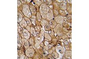 Formalin-fixed and paraffin-embedded human testis tissue (prostata carcinoma) reacted with CAMK1G (Center) , which was peroxidase-conjugated to the secondary antibody, followed by DAB staining. (CAMK1G antibody  (Center))