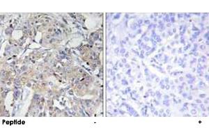 Immunohistochemistry analysis of paraffin-embedded human breast carcinoma tissue using COL6A3 polyclonal antibody . (COL6a3 antibody  (AA 2261-2310))