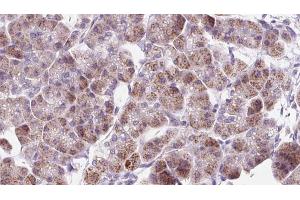 ABIN6273303 at 1/100 staining Human pancreas cancer tissue by IHC-P. (RAB12 antibody  (C-Term))