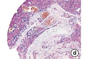 Immunhistochemistry image of OPN staining in paraffin sections of synovial tissue of pigmented villonodular synovitis (PVNS) patients. (Osteopontin antibody  (AA 164-179))