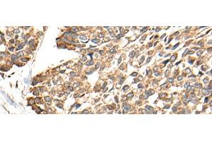 Immunohistochemistry of paraffin-embedded Human esophagus cancer tissue using RCAN3 Polyclonal Antibody at dilution of 1:60(x200) (RCAN3 antibody)