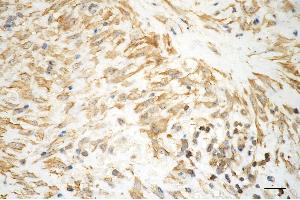 Immunohistochemistry was performed on paraffin-embedded human hepatocarcinoma using aggrecan antibody (ABIN7797541), 1:200). (Recombinant Aggrecan antibody)