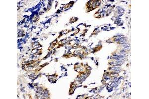 IHC-P: Beta Arrestin 2 antibody testing of human intestinal cancer tissue (Arrestin 3 antibody  (C-Term))
