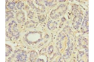 Immunohistochemistry of paraffin-embedded human breast cancer using ABIN7159004 at dilution of 1:100 (MAP3K7CL antibody  (AA 1-142))