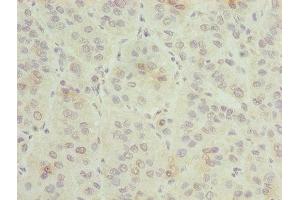 Immunohistochemistry of paraffin-embedded human liver cancer using ABIN7154676 at dilution of 1:100 (GNG5 antibody  (AA 2-65))