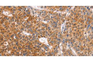Immunohistochemistry of paraffin-embedded Human liver cancer tissue using ABO Polyclonal Antibody at dilution 1:50 (ABO antibody)