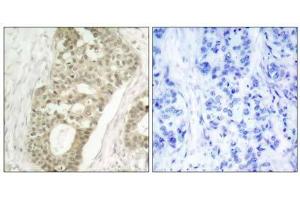 Immunohistochemical analysis of paraffin-embedded human breast carcinoma tissue using PKCδ (phospho- Ser645) antibody (E011296). (PKC delta antibody  (pSer645))