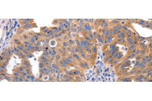 Immunohistochemistry of paraffin-embedded Human ovarian cancer tissue using IRS2 Polyclonal Antibody at dilution 1:100 (IRS2 antibody)