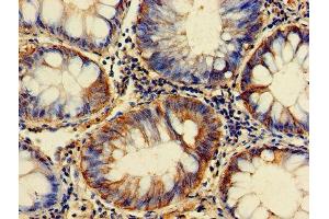 Immunohistochemistry of paraffin-embedded human colon cancer using ABIN7153928 at dilution of 1:100 (GPI antibody  (AA 2-554))