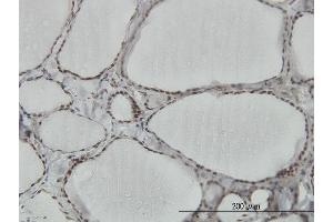 Immunoperoxidase of monoclonal antibody to HNRPM on formalin-fixed paraffin-embedded human thyroid nodular goiter. (HNRNPM antibody  (AA 17-112))
