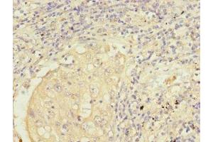 Immunohistochemistry of paraffin-embedded human lung cancer using ABIN7149955 at dilution of 1:100 (FMO2 antibody  (AA 210-470))