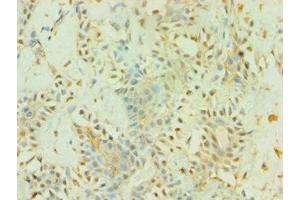 Immunohistochemistry of paraffin-embedded human breast cancer using ABIN7145226 at dilution of 1:100 (BAG5 antibody  (AA 198-447))