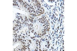 Immunohistochemistry of paraffin-embedded human colon carcinoma using P Rabbit pAb (ABIN3022375, ABIN3022376, ABIN3022377, ABIN1513310 and ABIN6218769) at dilution of 1:150 (40x lens). (Paired Box 3 antibody  (AA 1-206))