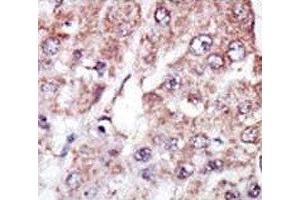 IHC analysis of FFPE human hepatocarcinoma stained with the MARK2 antibody (MARK2 antibody  (AA 600-630))