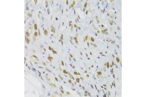 Immunohistochemistry of paraffin-embedded human gastric cancer using DOK1 Antibody (ABIN6130881, ABIN6139763, ABIN6139764 and ABIN6221343) at dilution of 1:100 (40x lens). (DOK1 antibody  (AA 1-280))