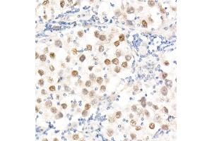 Immunohistochemistry of paraffin-embedded Human testicular seminoma using Nanog Rabbit pAb (ABIN1680964, ABIN3017620, ABIN3017621 and ABIN6220166) at dilution of 1:25 (40x lens).