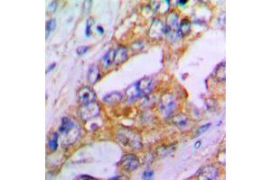 Immunohistochemical analysis of Aggrecan staining in human lung cancer formalin fixed paraffin embedded tissue section. (Aggrecan antibody  (N-Term))