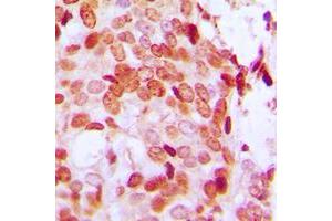 Immunohistochemical analysis of DAXX (pS668) staining in human breast cancer formalin fixed paraffin embedded tissue section. (DAXX antibody  (C-Term, pSer668))