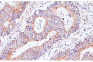 Immunohistochemistry of paraffin-embedded Human colon carcinoma using RAP1A Polyclonal Antibody at dilution of 1:100 (40x lens). (RAP1A antibody)