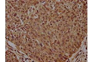 IHC image of ABIN7155407 diluted at 1:300 and staining in paraffin-embedded human cervical cancer performed on a Leica BondTM system. (Histone 2b (HIST1H2BL) (AA 2-126) antibody)
