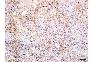 Formalin-fixed and paraffin embedded human colorectal cancer labeled with Anti SLC27A2 Polyclonal Antibody, Unconjugated (ABIN751393) followed by conjugation to the secondary antibody and DAB staining (SLC27A2 antibody  (AA 401-500))