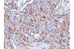 Formalin-fixed, paraffin-embedded human Breast Carcinoma stained with CD44 Mouse Monoclonal Antibody (156-3C11). (CD44 antibody)