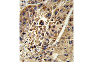 Formalin-fixed and paraffin-embedded human hepatocarcinoma reacted with KMO Antibody (Center), which was peroxidase-conjugated to the secondary antibody, followed by DAB staining. (KMO antibody  (AA 155-182))