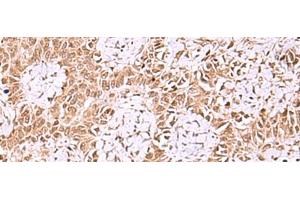 Immunohistochemistry of paraffin-embedded Human ovarian cancer tissue using IRX1 Polyclonal Antibody at dilution of 1:35(x200) (IRX1 antibody)