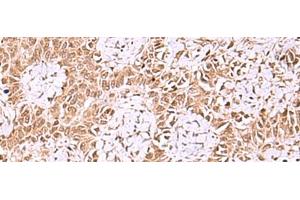 Immunohistochemistry of paraffin-embedded Human ovarian cancer tissue using IRX1 Polyclonal Antibody at dilution of 1:35(x200)