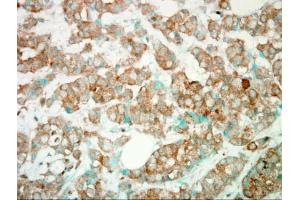 IHC-P Image Immunohistochemical analysis of paraffin-embedded Human Breast Cancer, using PI3K gamma, antibody. (PIK3 gamma antibody  (C-Term))