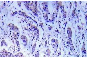 Immunohistochemistry (IHC) analyzes of ASK1 antibody in paraffin-embedded human breast carcinoma tissue. (ASK1 antibody)