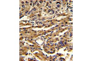 Formalin-fixed and paraffin-embedded human hepatocarcinoma reacted with ABCG1 Antibody (Center), which was peroxidase-conjugated to the secondary antibody, followed by DAB staining. (ABCG1 antibody  (AA 359-387))