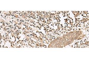 Immunohistochemistry of paraffin-embedded Human esophagus cancer tissue using FGF13 Polyclonal Antibody at dilution of 1:45(x200) (FGF13 antibody)