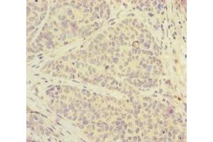 Immunohistochemistry of paraffin-embedded human ovarian cancer using ABIN7152525 at dilution of 1:100