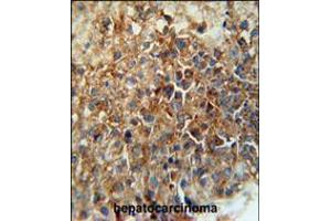 CD46 Antibody immunohistochemistry analysis in formalin fixed and paraffin embedded human hepatocarcinoma followed by peroxidase conjugation of the secondary antibody and DAB staining.