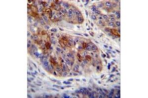 Imunohistochemistry analysis in formalin fixed and paraffin embedded human esophageal carcinoma reacted with HAX1 Antibody (C-term) followed by peroxidase conjugation of the secondary antibody and DAB staining. (HAX1 antibody  (C-Term))