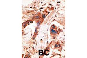 Formalin-fixed and paraffin-embedded human cancer tissue reacted with BMP2K polyclonal antibody  , which was peroxidase-conjugated to the secondary antibody, followed by AEC staining. (BMP2K antibody  (Internal Region))