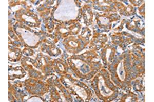 The image on the left is immunohistochemistry of paraffin-embedded Human thyroid cancer tissue using ABIN7130296(MTMR7 Antibody) at dilution 1/40, on the right is treated with fusion protein. (MTMR7 antibody)