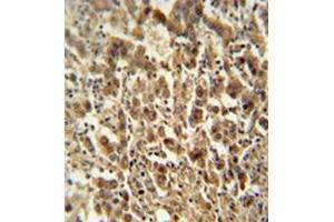 Formalin fixed and paraffin embedded human testis carcinoma reacted with DIS3 Antibody  followed by peroxidase conjugation of the secondary antibody and DAB staining. (DIS3 antibody  (Middle Region))