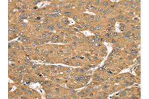 The image on the left is immunohistochemistry of paraffin-embedded Human liver cancer tissue using ABIN7192541(SLIT1 Antibody) at dilution 1/35, on the right is treated with synthetic peptide. (SLIT1 antibody)