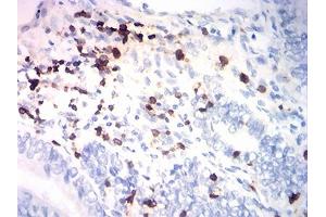 Immunohistochemical analysis of paraffin-embedded endometrial cancer tissues using CD7 mouse mAb with DAB staining. (CD7 antibody  (AA 26-180))