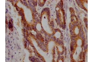 IHC image of ABIN7127586 diluted at 1:100 and staining in paraffin-embedded human colon cancer performed on a Leica BondTM system. (Recombinant JAK1 antibody)